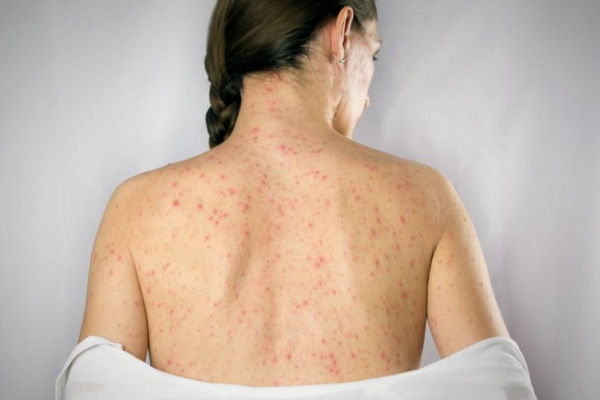 Природні способи позбавлення від шкірної алергії