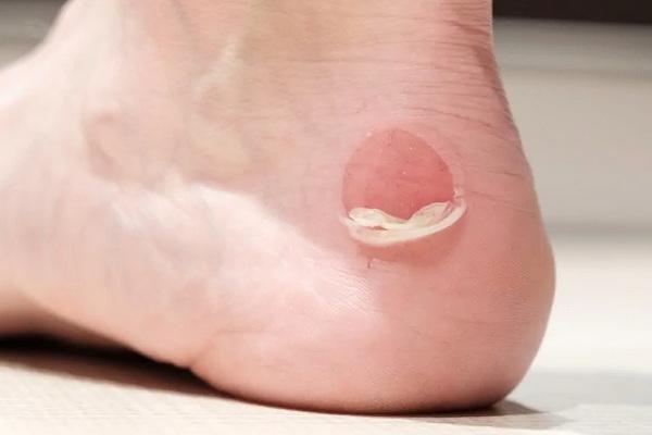 Пухирі на ногах — як їх правильно лікувати? Думка дерматолога!