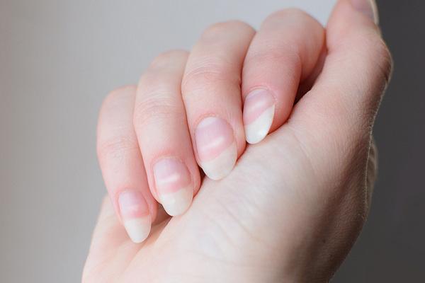 Білі плями на нігтях: причини, симптоми