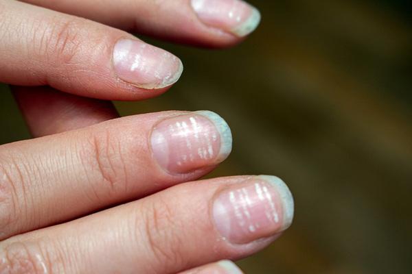 Що означають білі нігті?