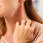 Еритема на обличчі та шиї: причини, симптоми та лікування