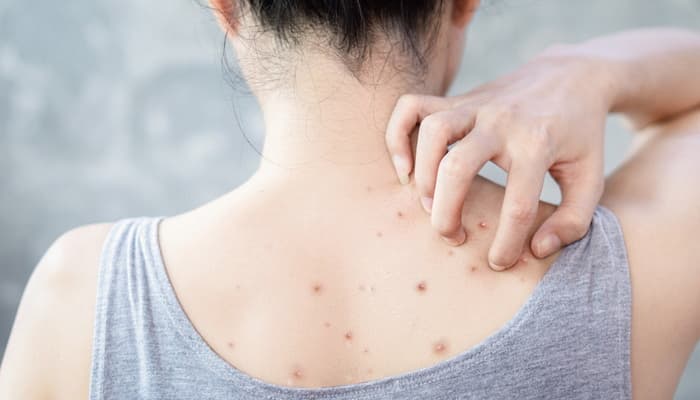 Як позбутися прищів на спині: причини та лікування?