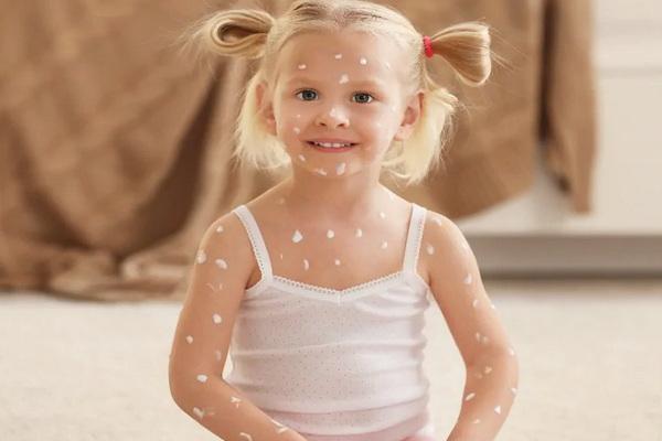 Where do chickenpox scar come from?