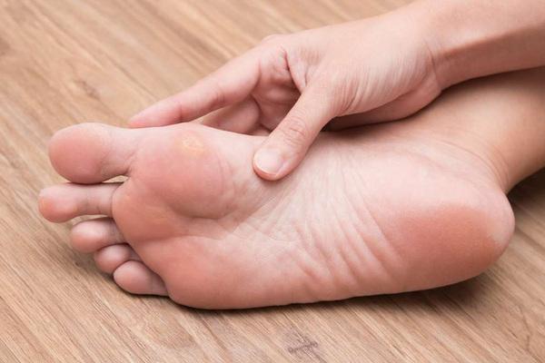Корисні поради від мозолів на ногах