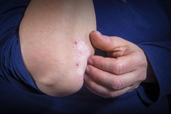 Суха шкіра: симптоми серйозних захворювань