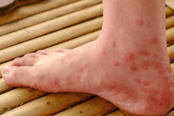 Симптоми алергії на воду