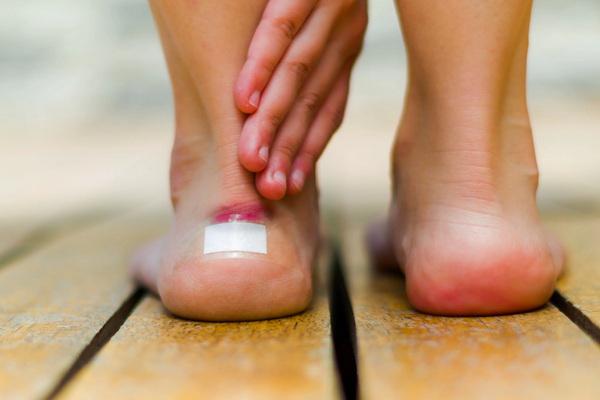 Пухирі на ногах — як їх правильно лікувати?