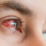 Алергічний кон'юнктивіт – як із ним боротися?