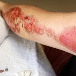 Некроз шкіри – коли може виникнути і як лікувати?